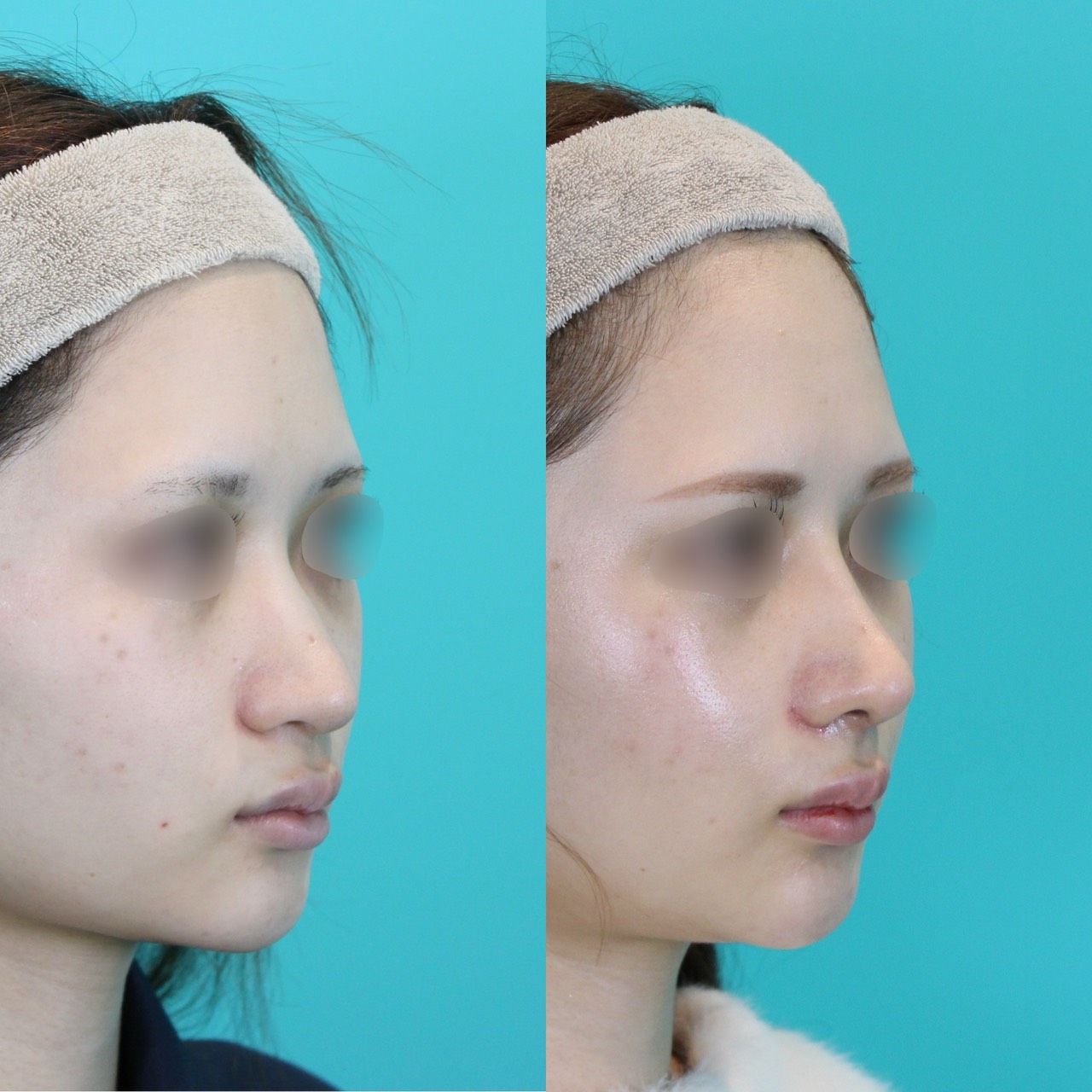 施術前後イメージ