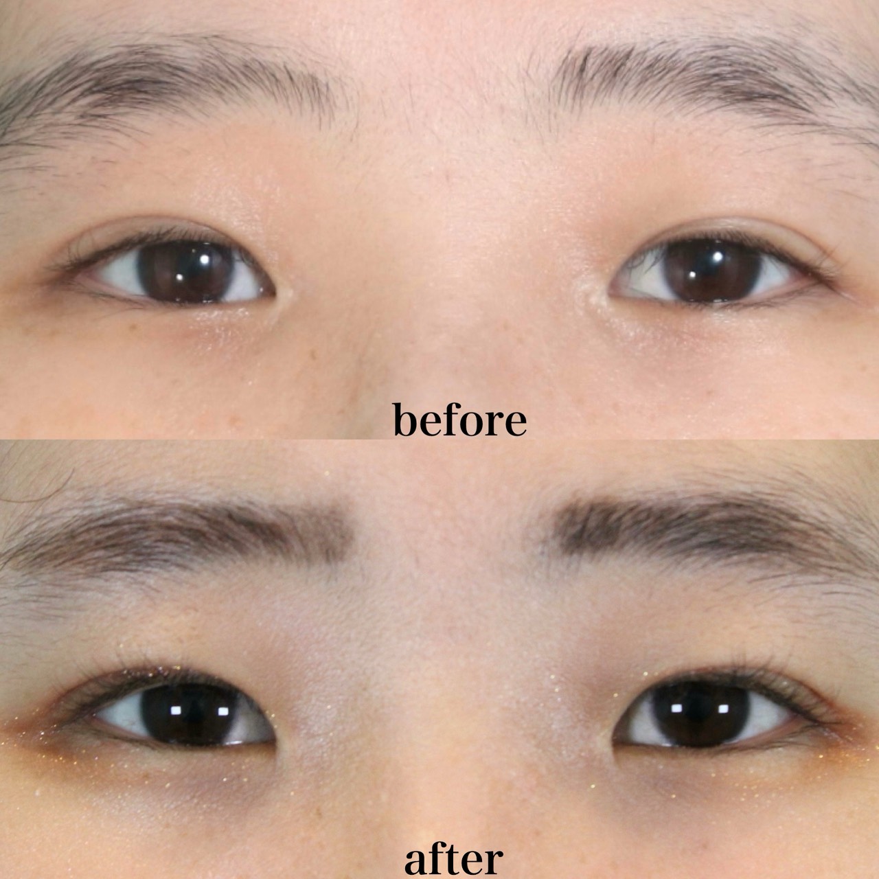 目頭切開修正施術前後イメージ