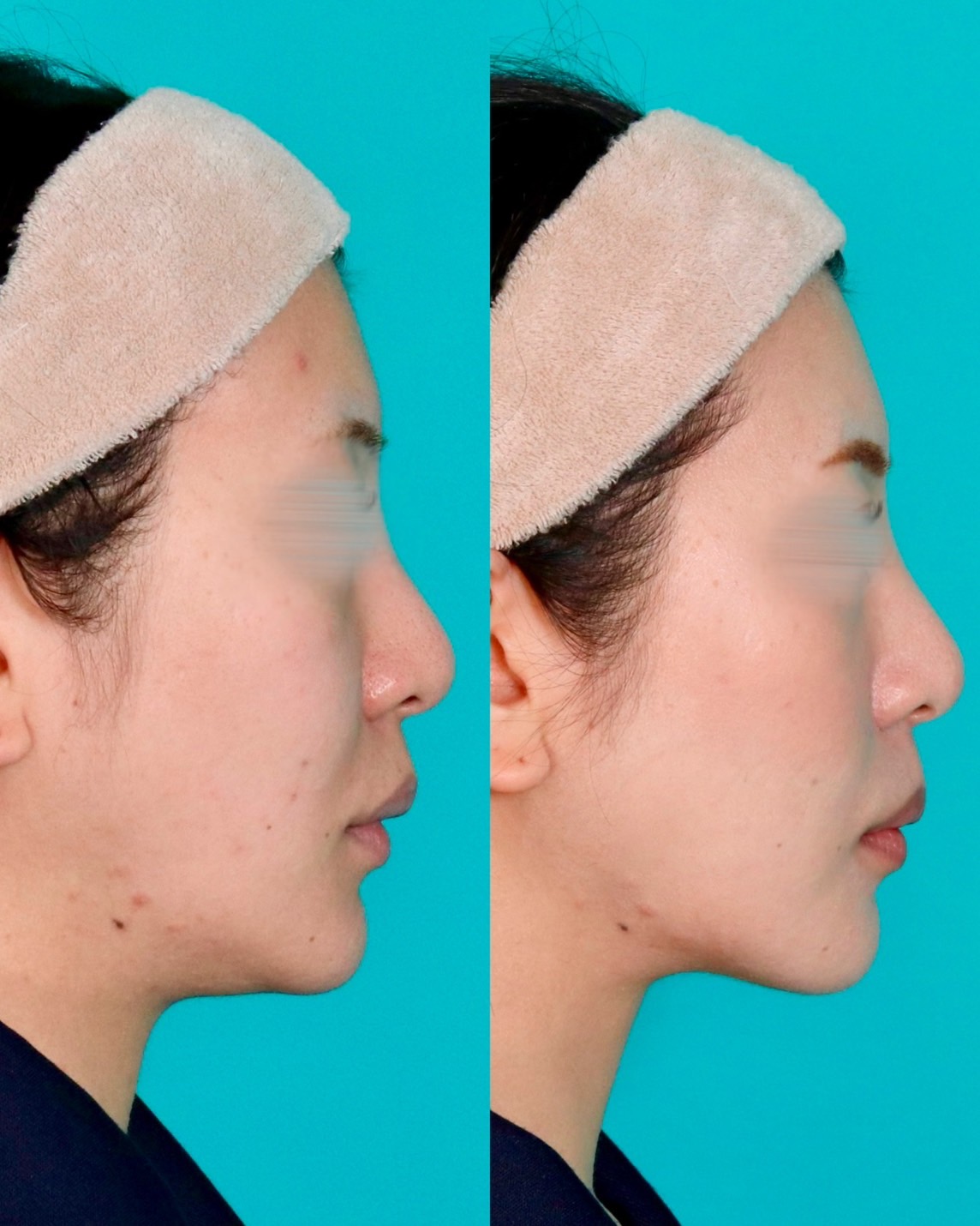 施術前後イメージ