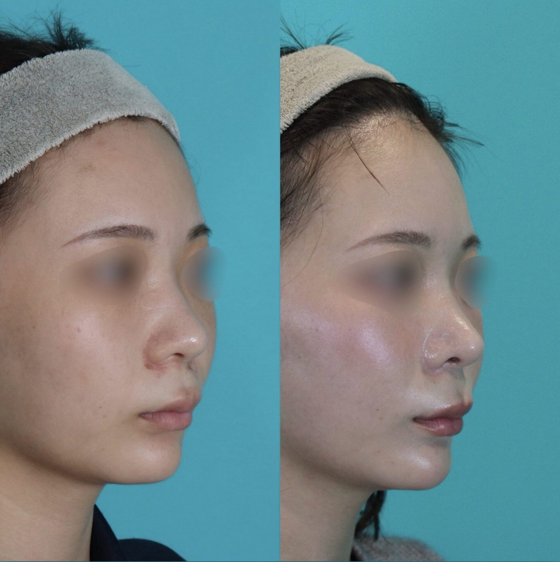 施術前後イメージ