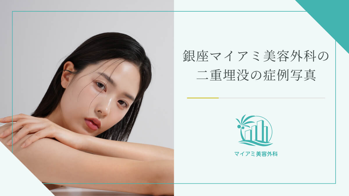 銀座マイアミ美容外科の二重埋没の症例写真