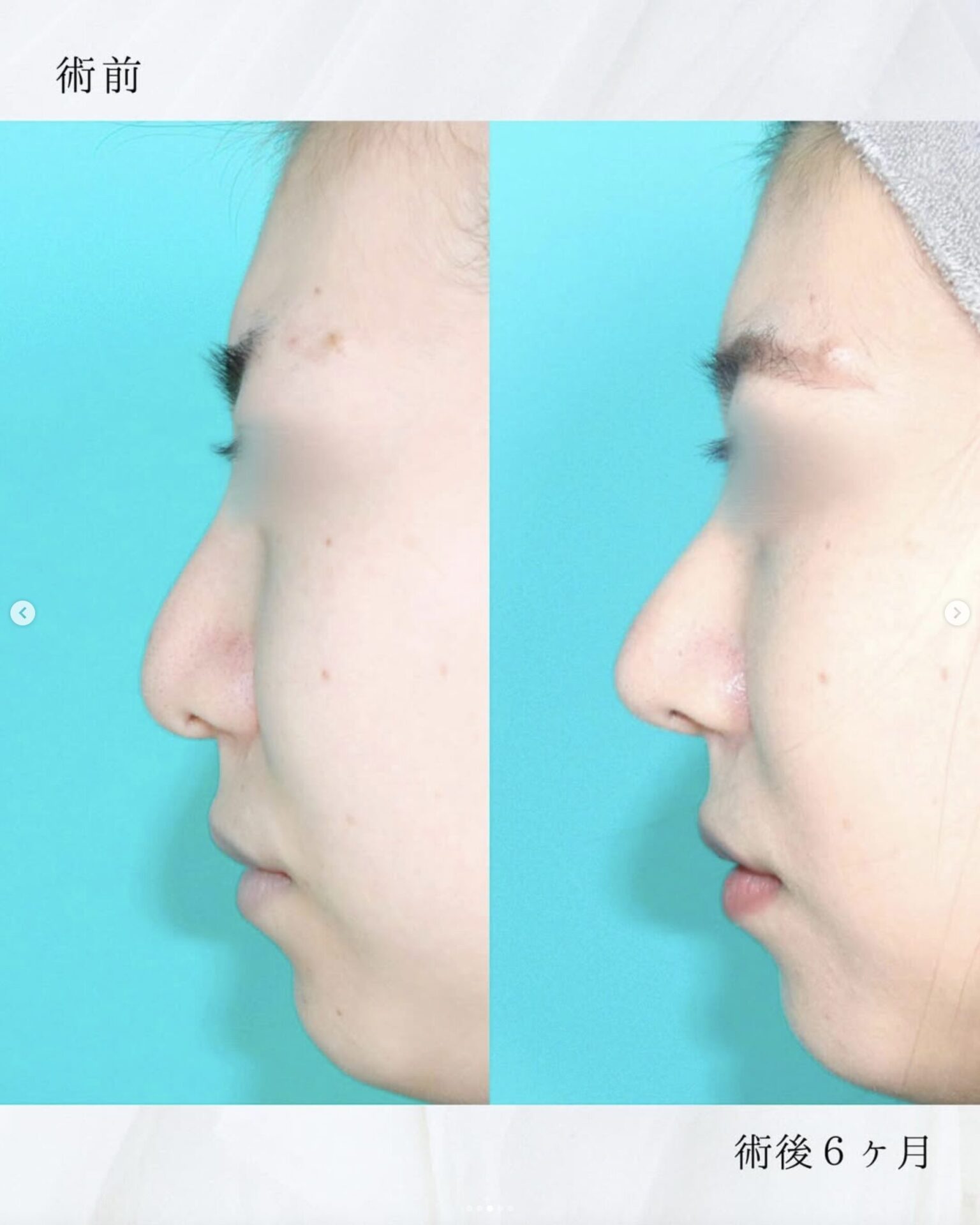 施術前後イメージ