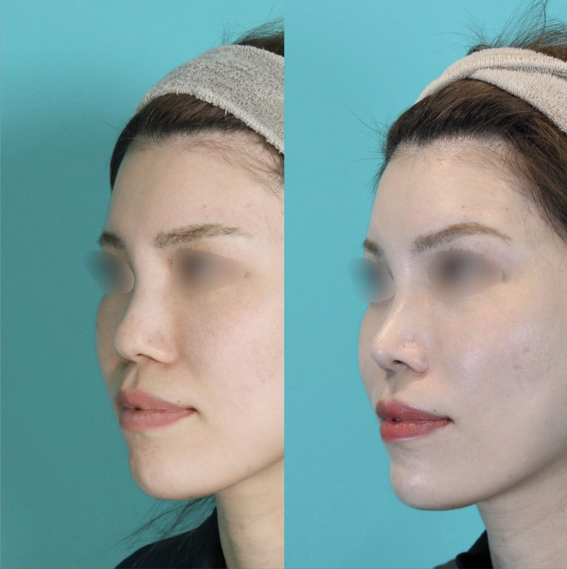 施術前後イメージ