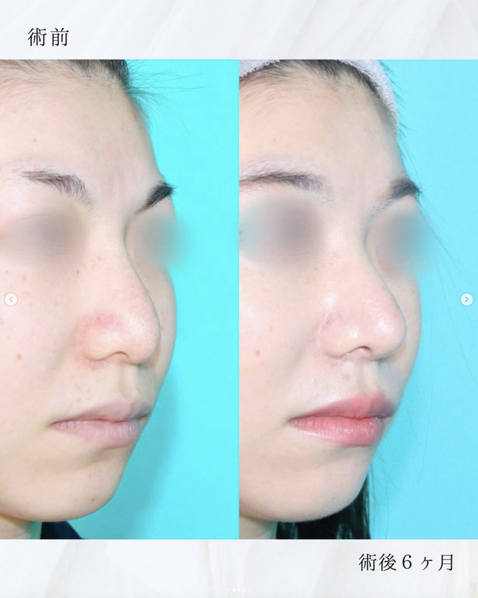 施術前後イメージ
