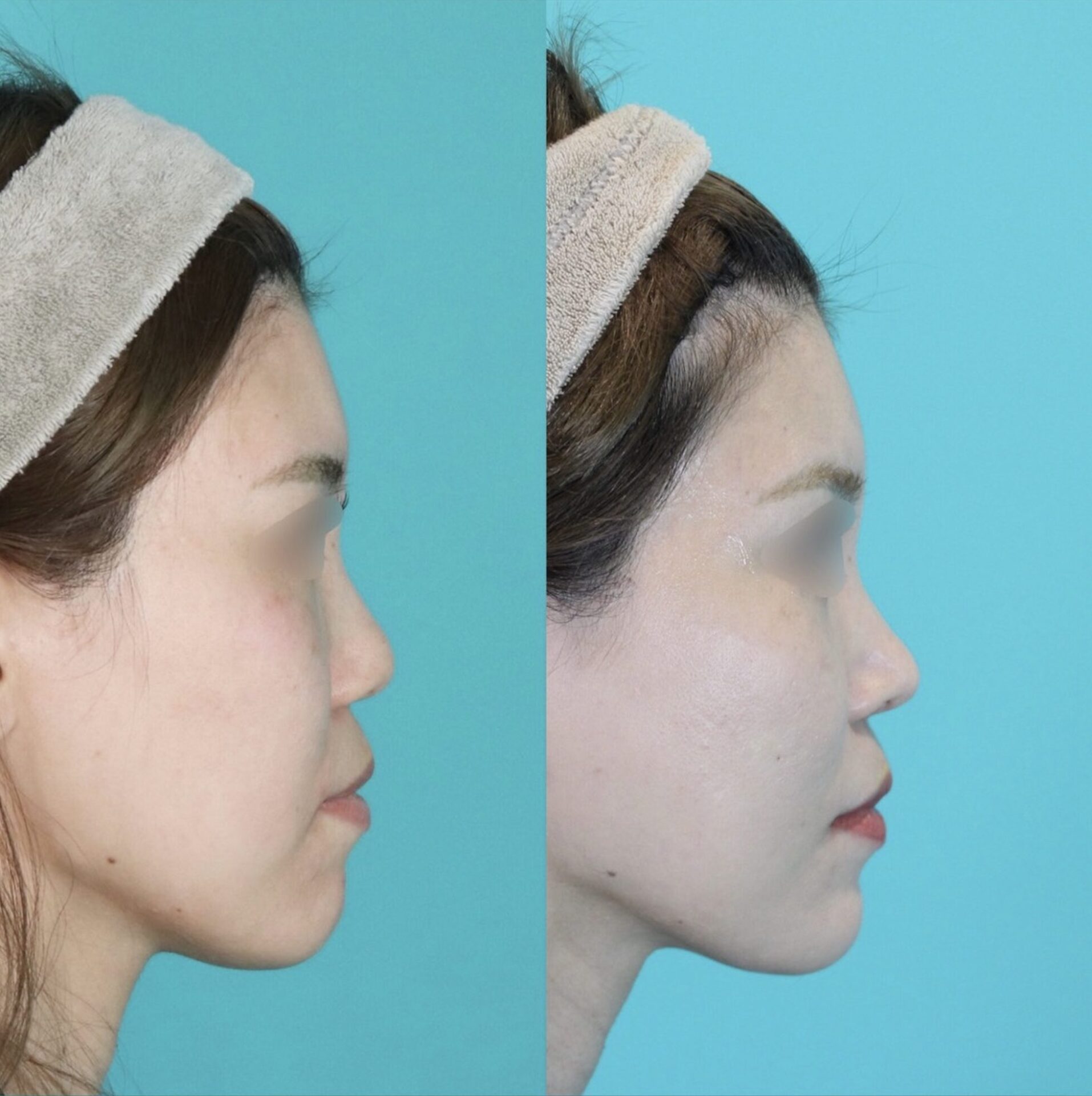 施術前後イメージ