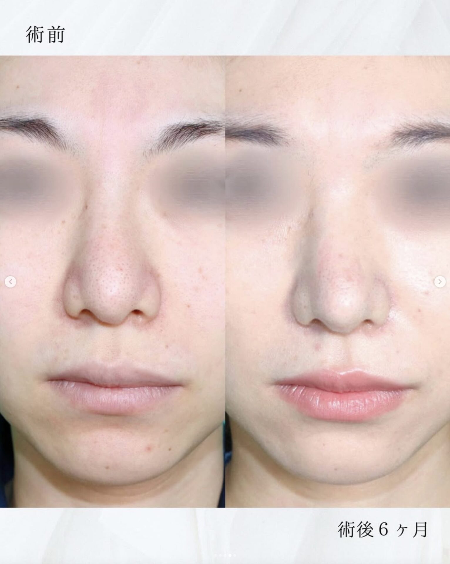 鼻フルコースプレミアム　２０代女性施術前後イメージ