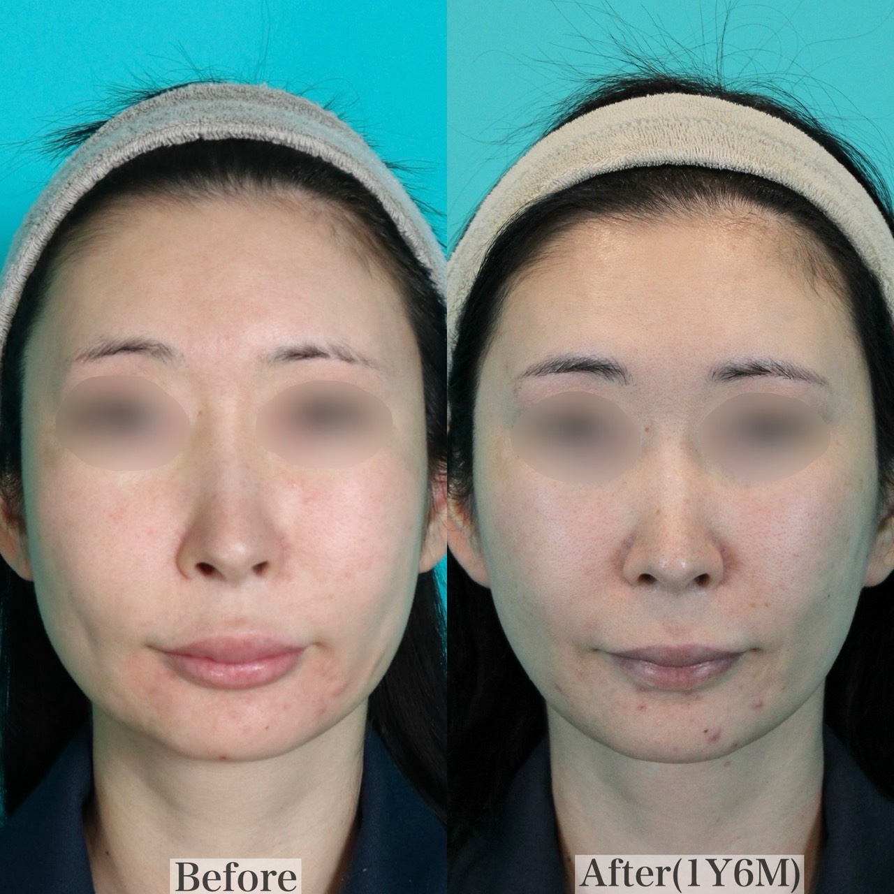 フルフェイスリフト施術前後イメージ