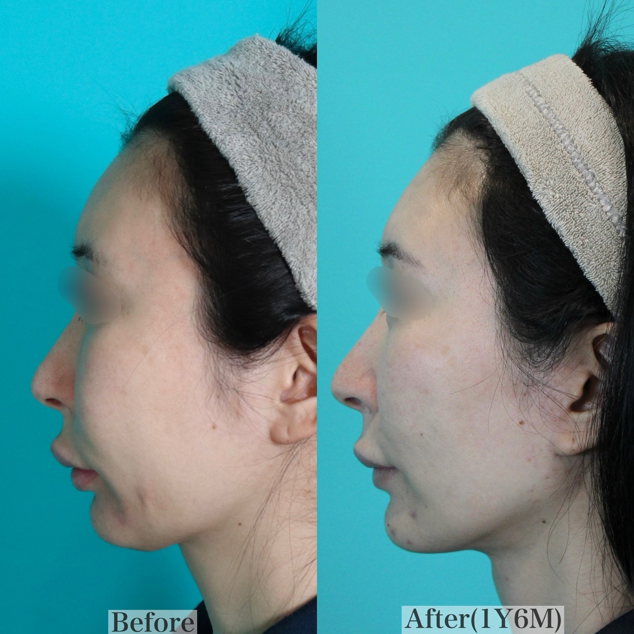 施術前後イメージ