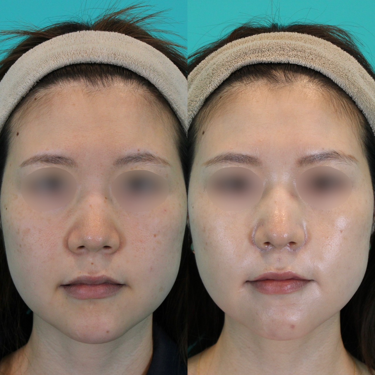 施術前後イメージ