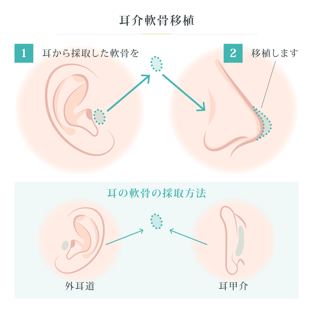 軟骨(耳介軟骨、肋軟骨)