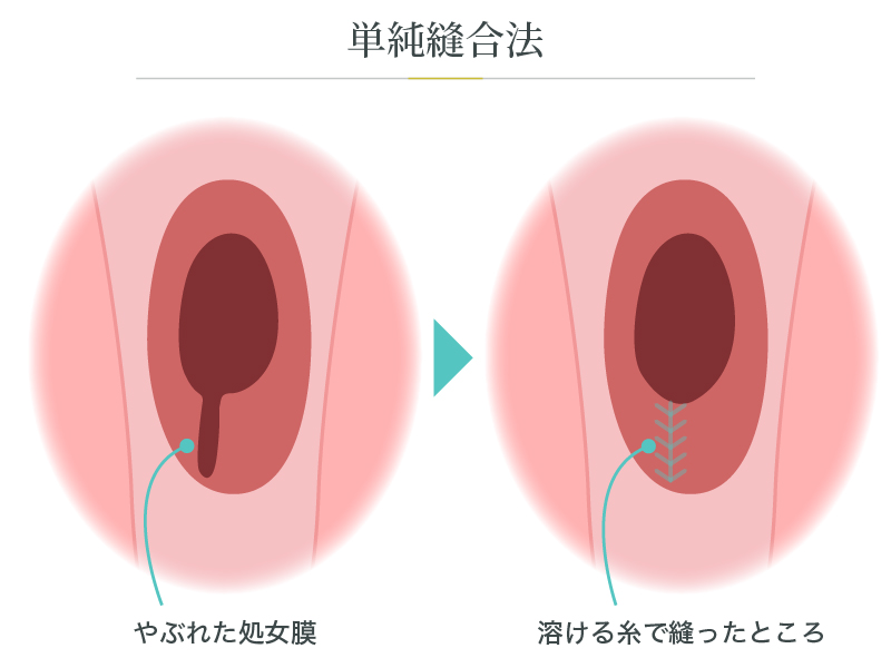 プチ処女膜再生（単純縫合法）