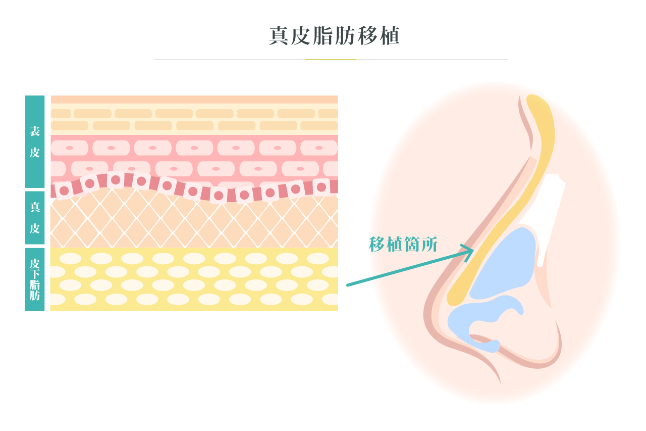 真皮脂肪移植