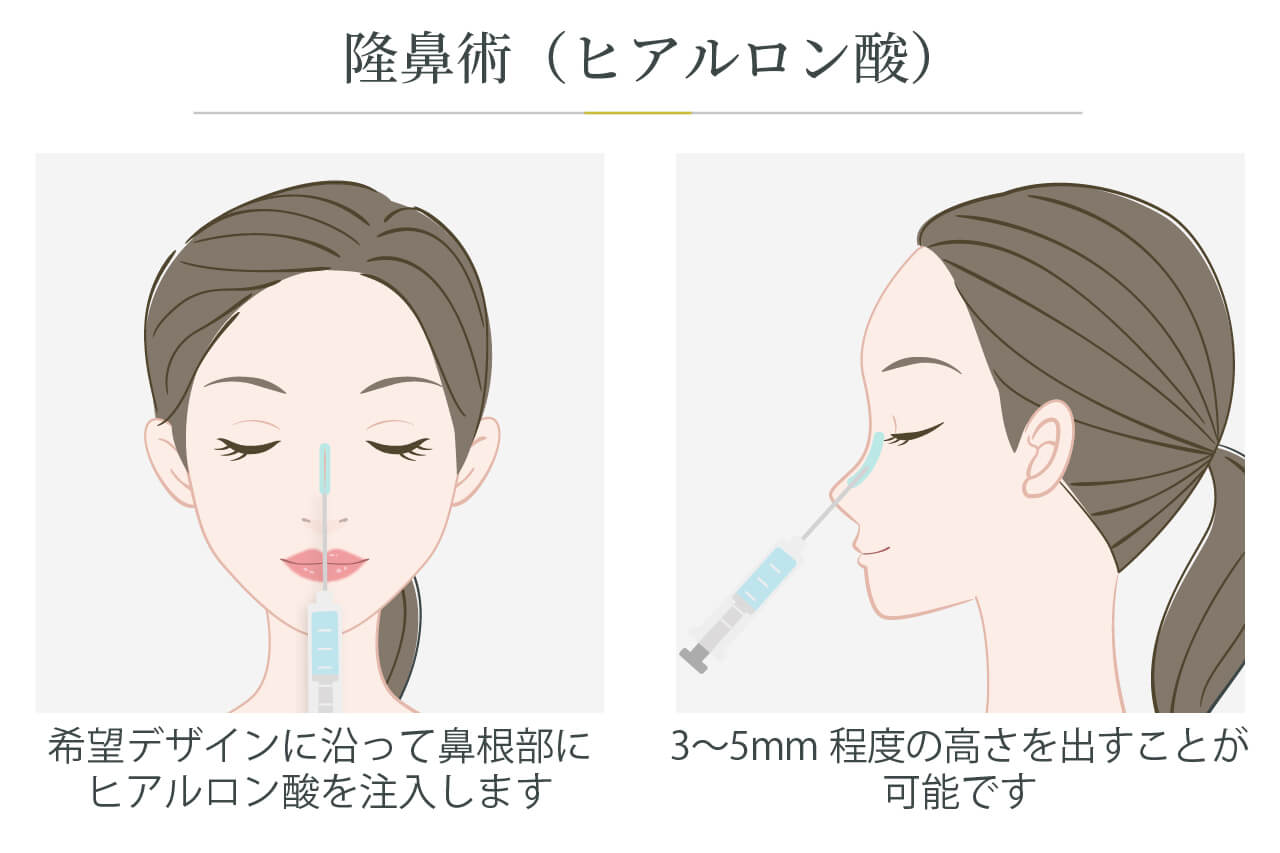 隆鼻術(ヒアルロン酸)