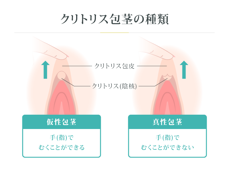 クリトリス包茎の種類