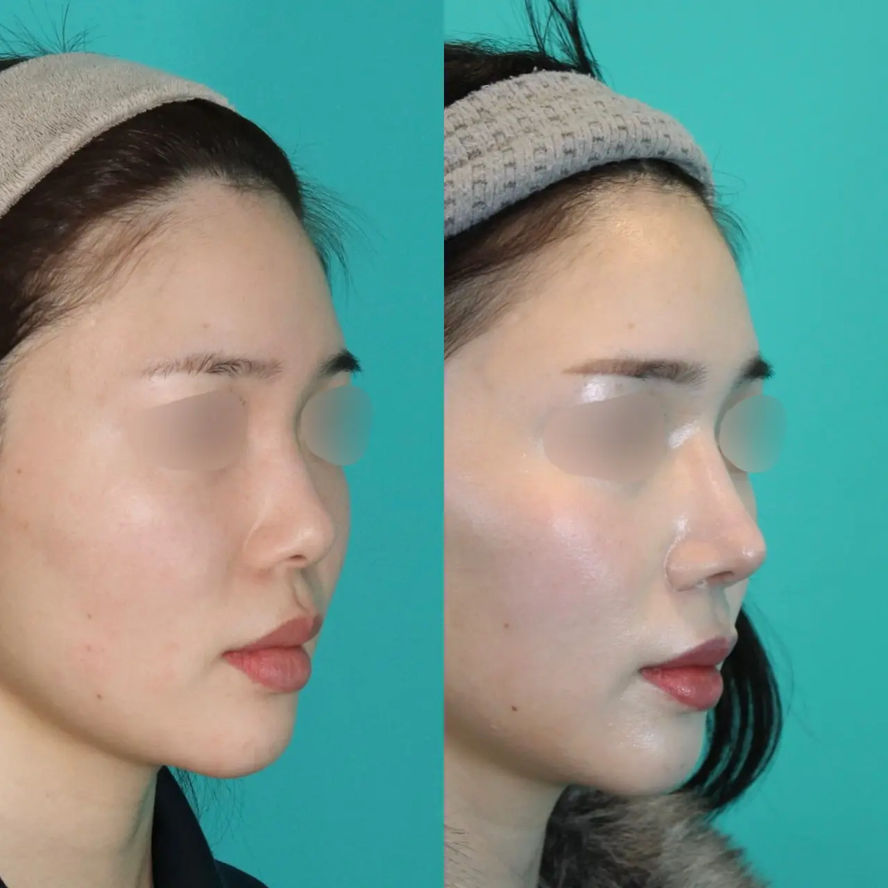 施術前後イメージ