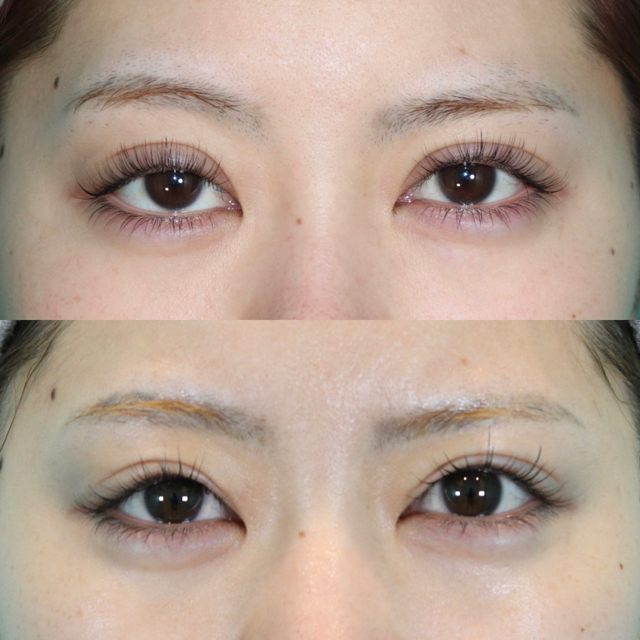 二重全切開、挙筋短縮施術前後イメージ