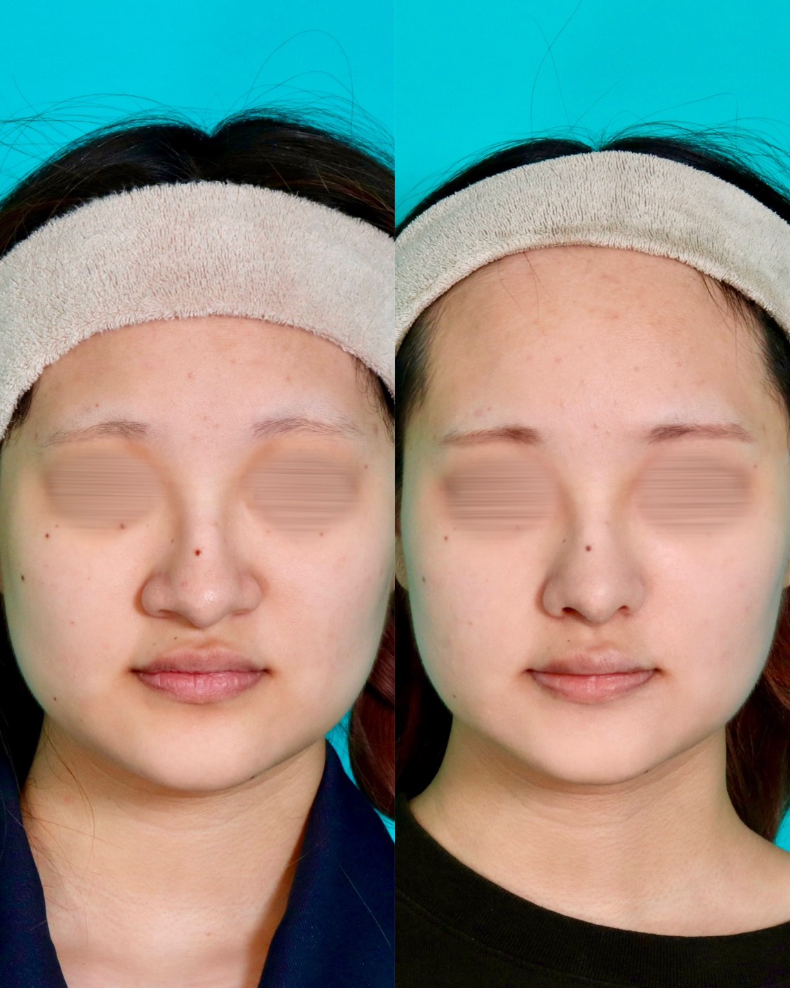 施術前後イメージ