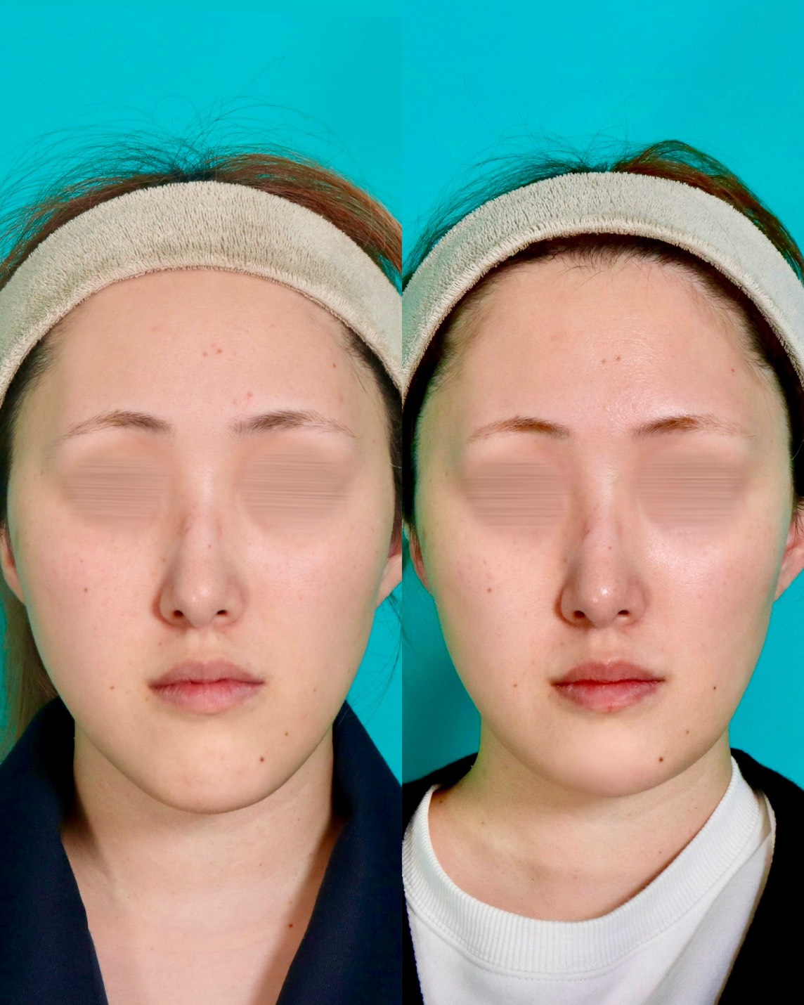 施術前後イメージ