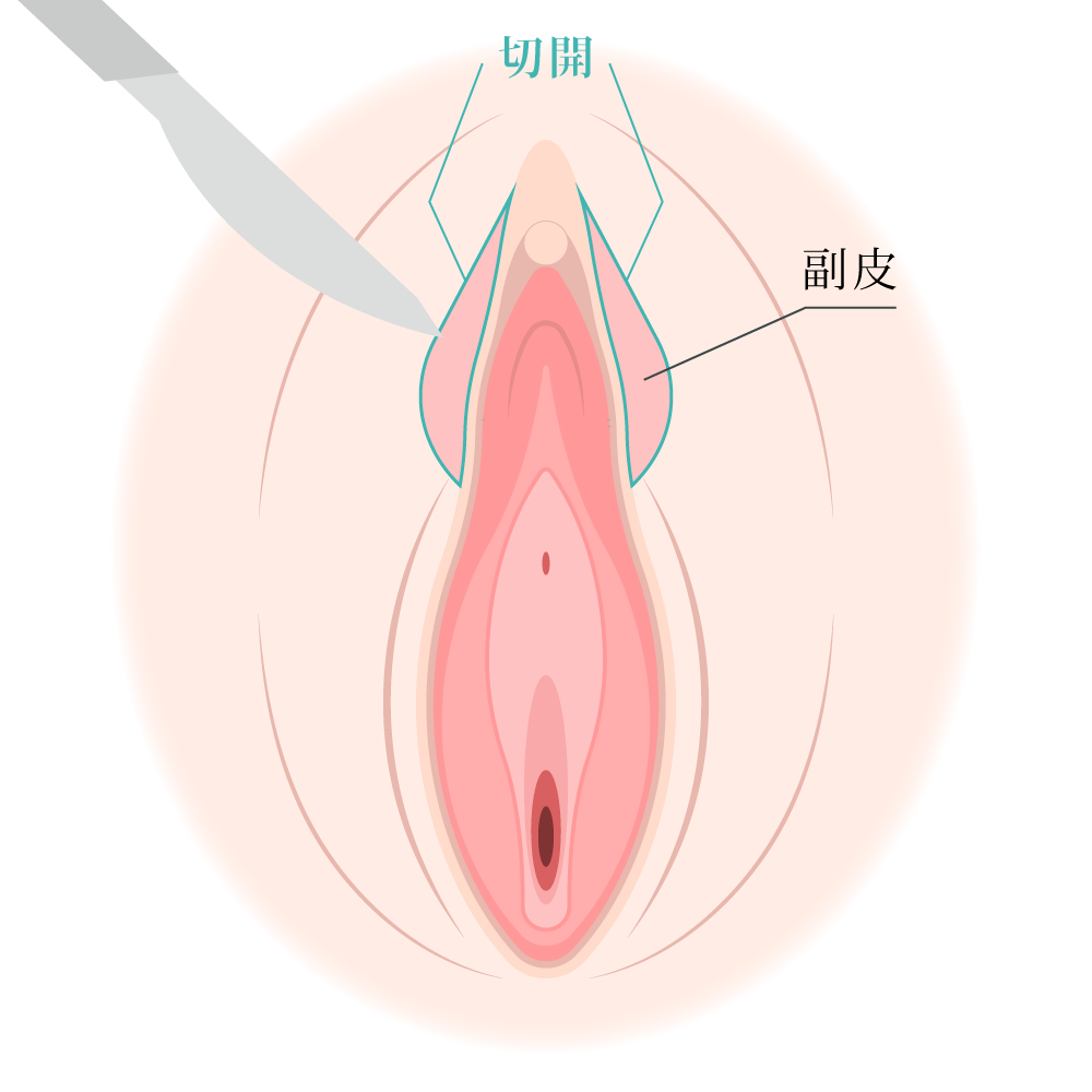 2.余分な皮膚を切除