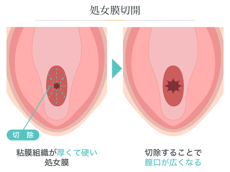 処女膜切開