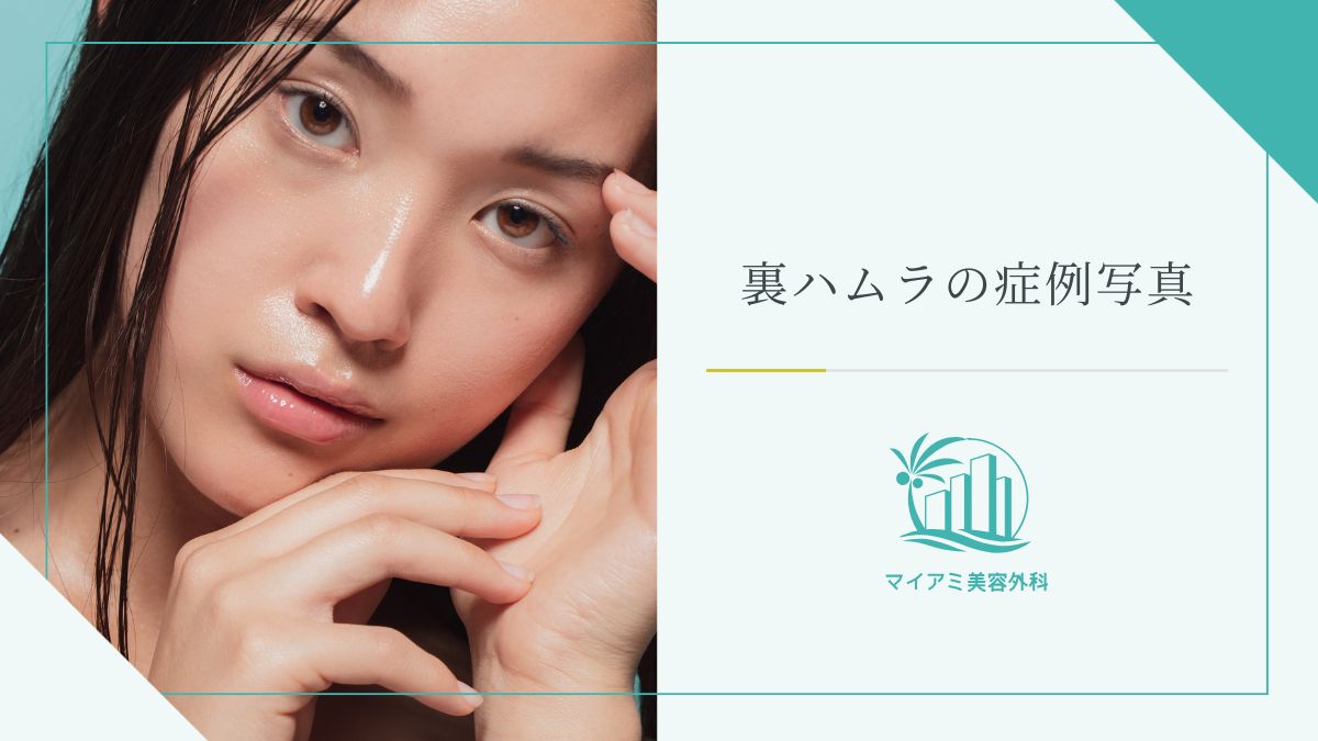 裏ハムラの症例写真