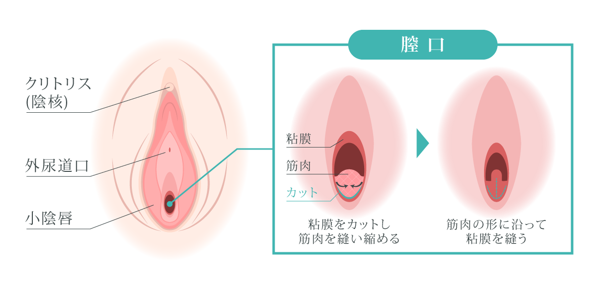 膣粘膜の切除・骨盤底筋の修復