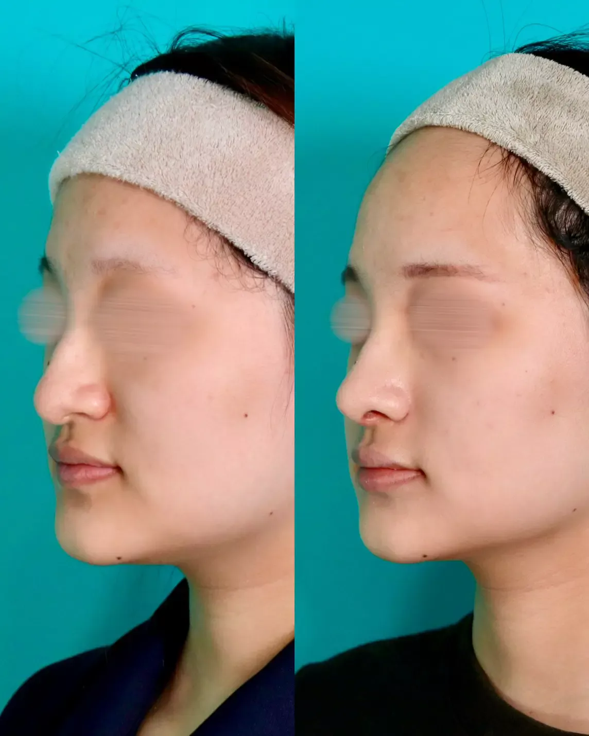 施術前後イメージ