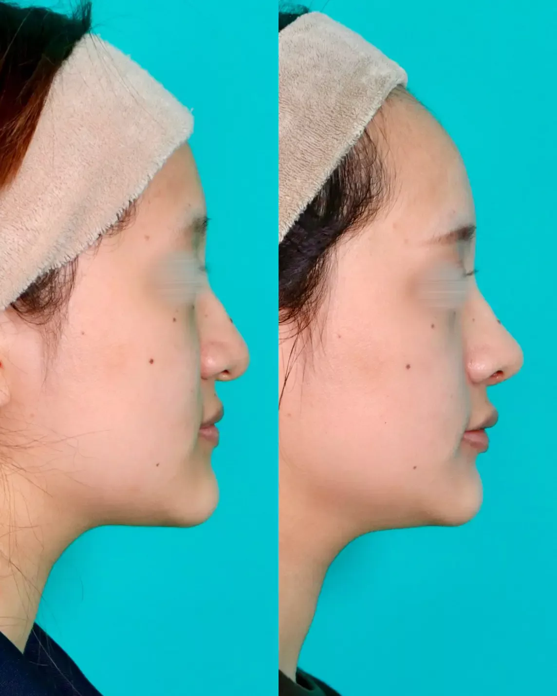 施術前後イメージ