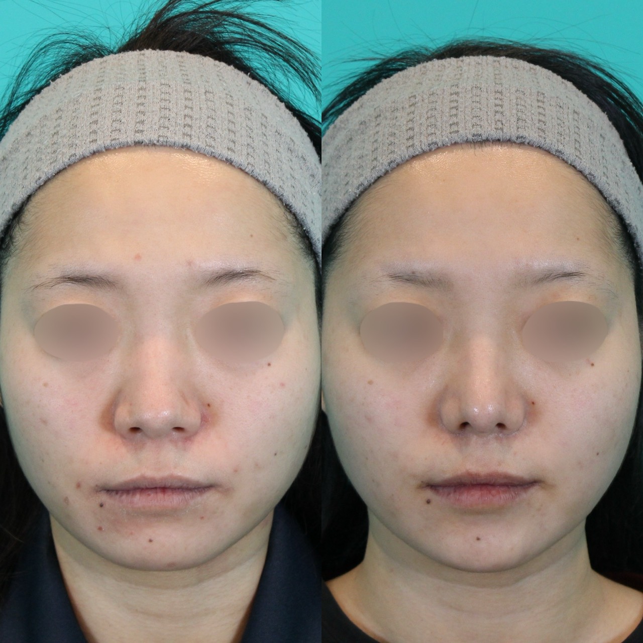 施術前後イメージ