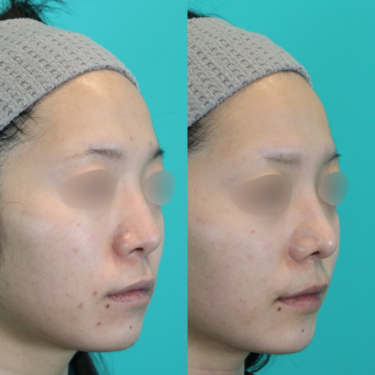 施術前後イメージ