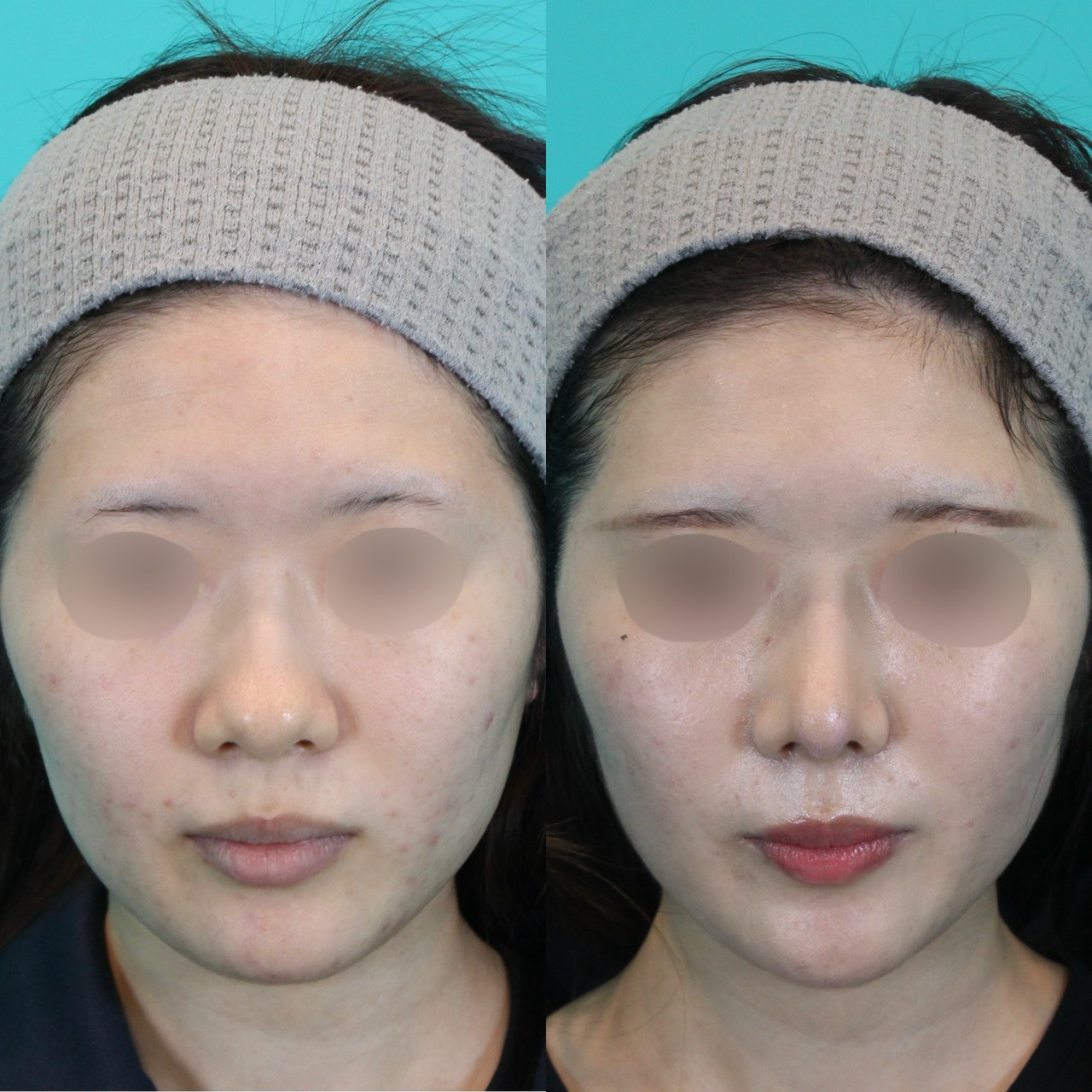 施術前後イメージ