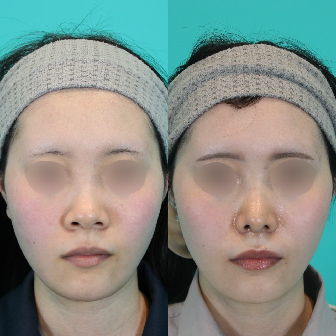 施術前後イメージ