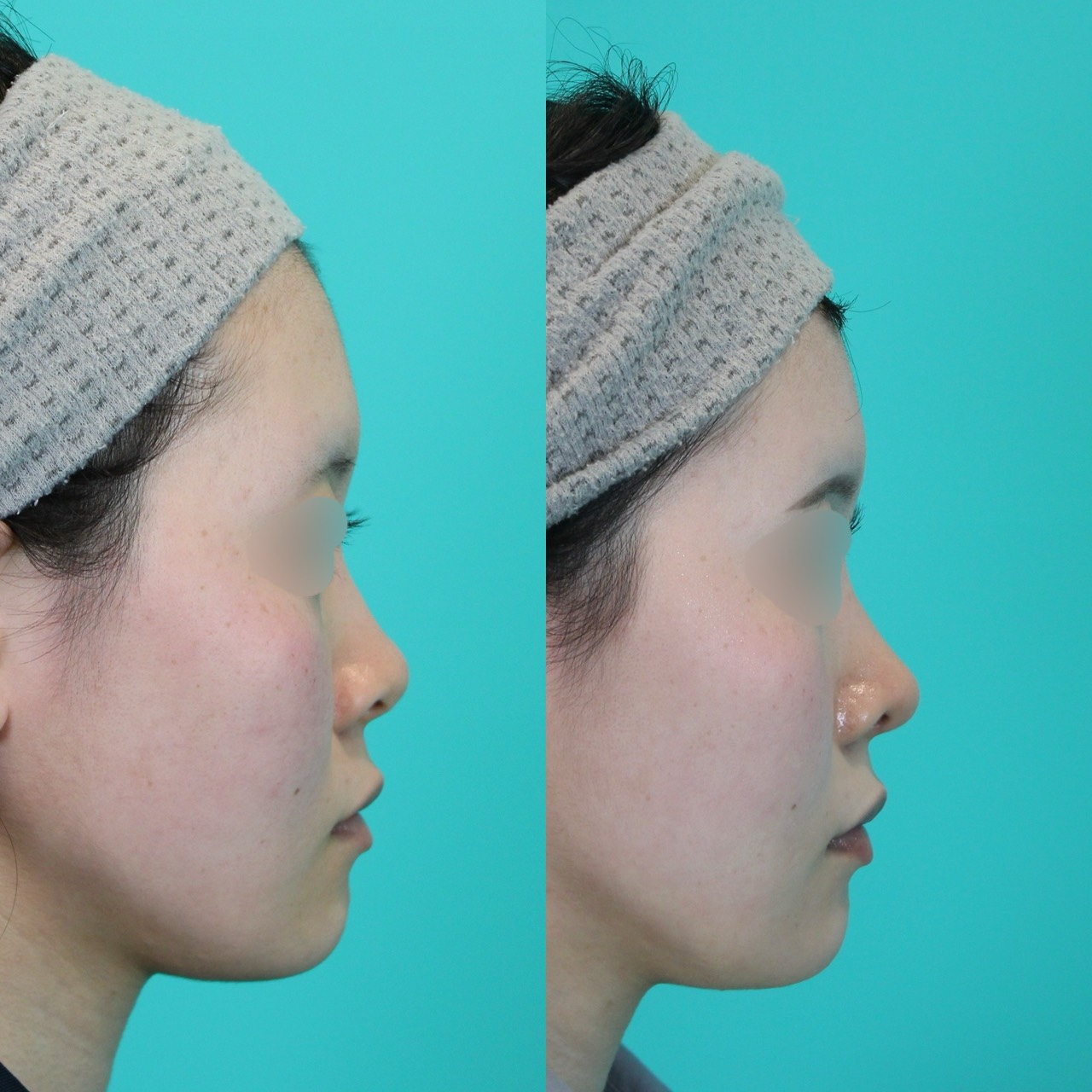 施術前後イメージ