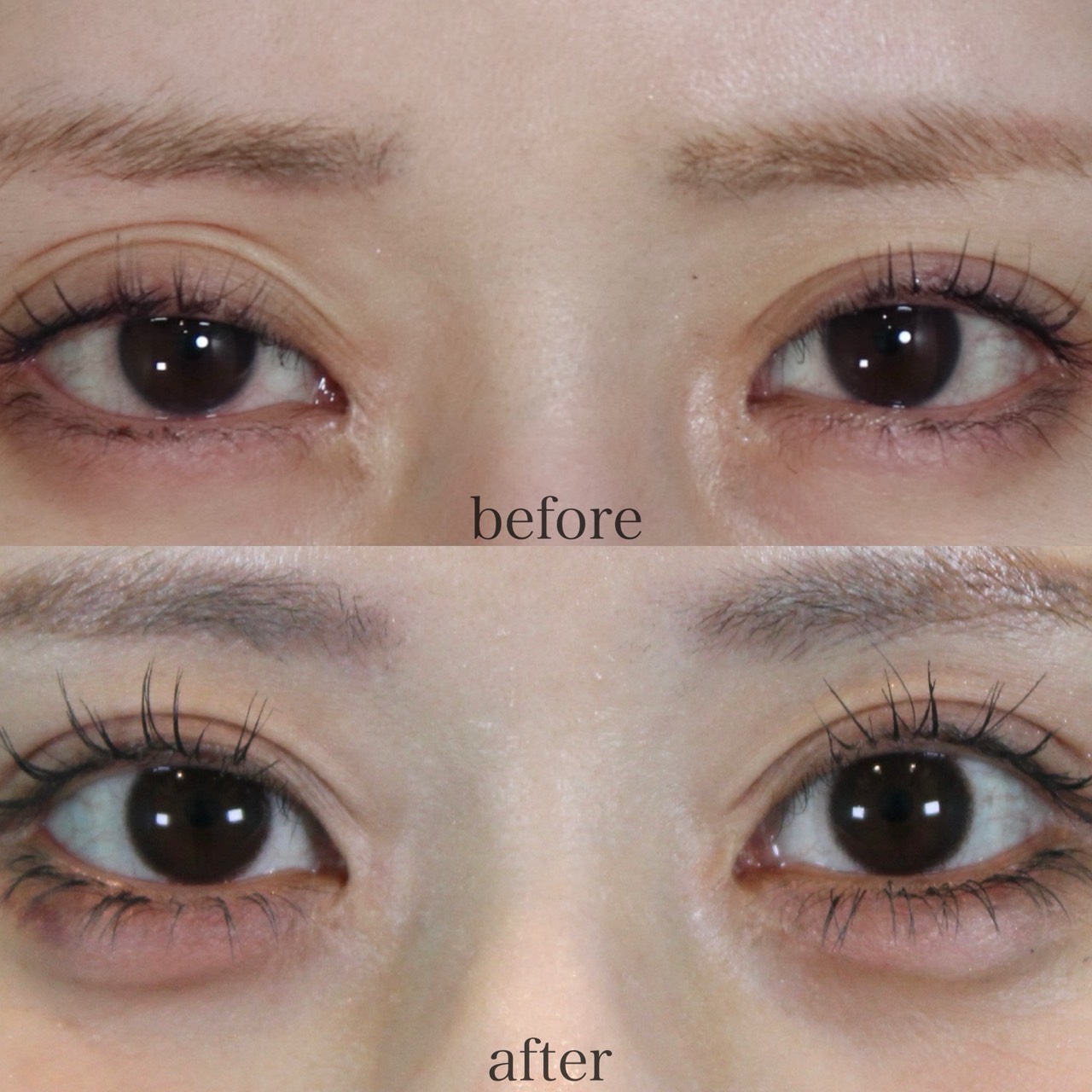 目頭切開他院修正施術前後イメージ