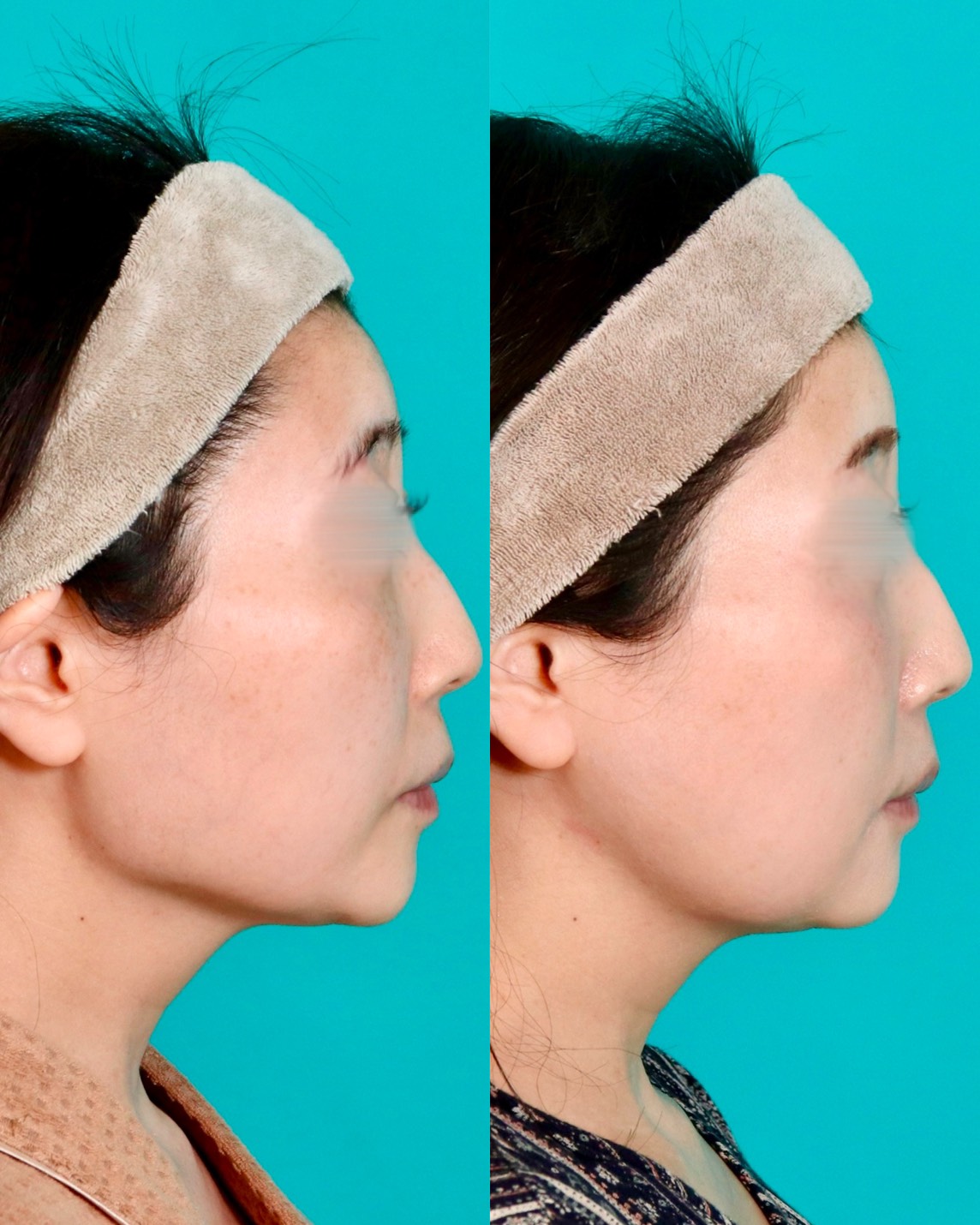 施術前後イメージ