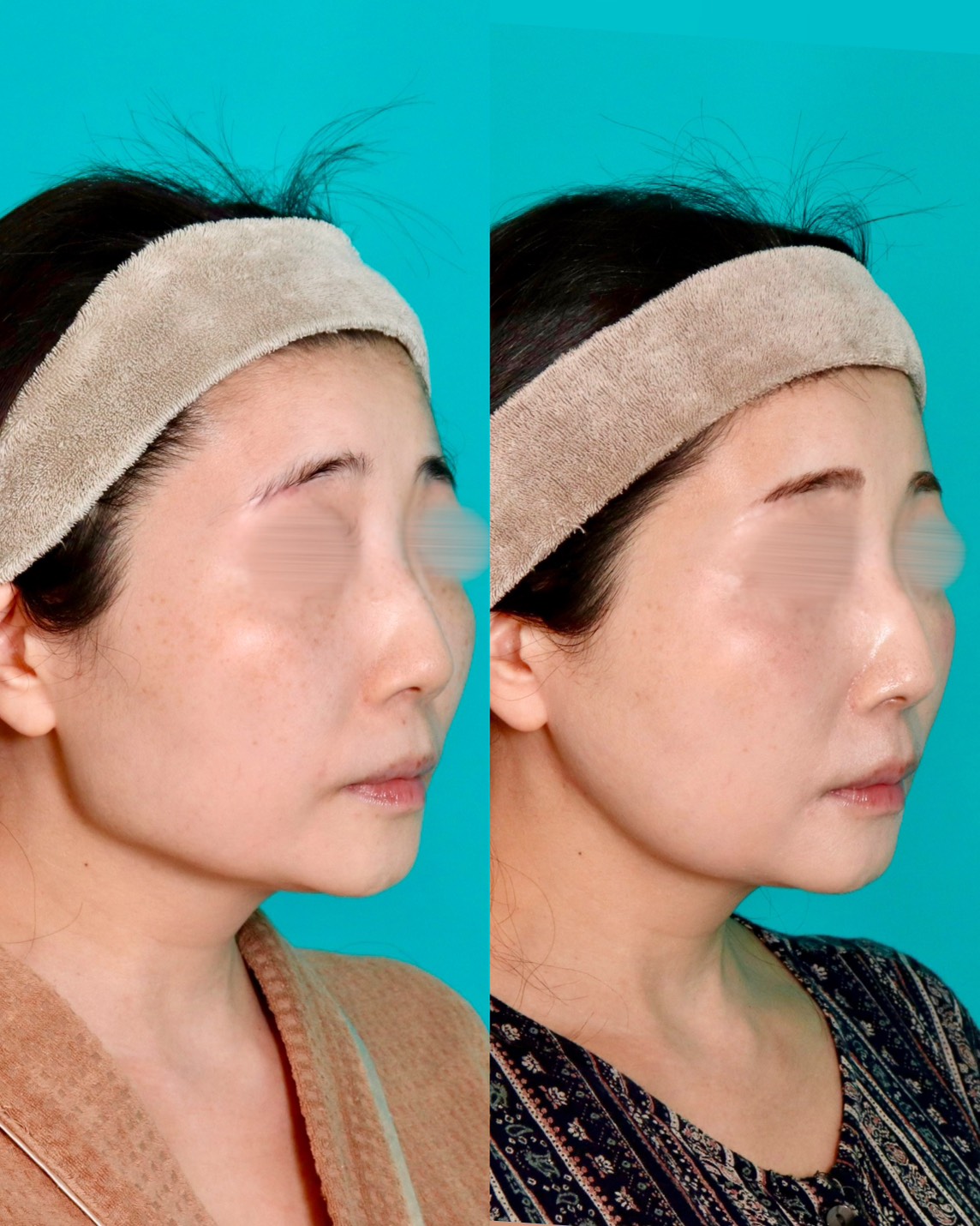 施術前後イメージ