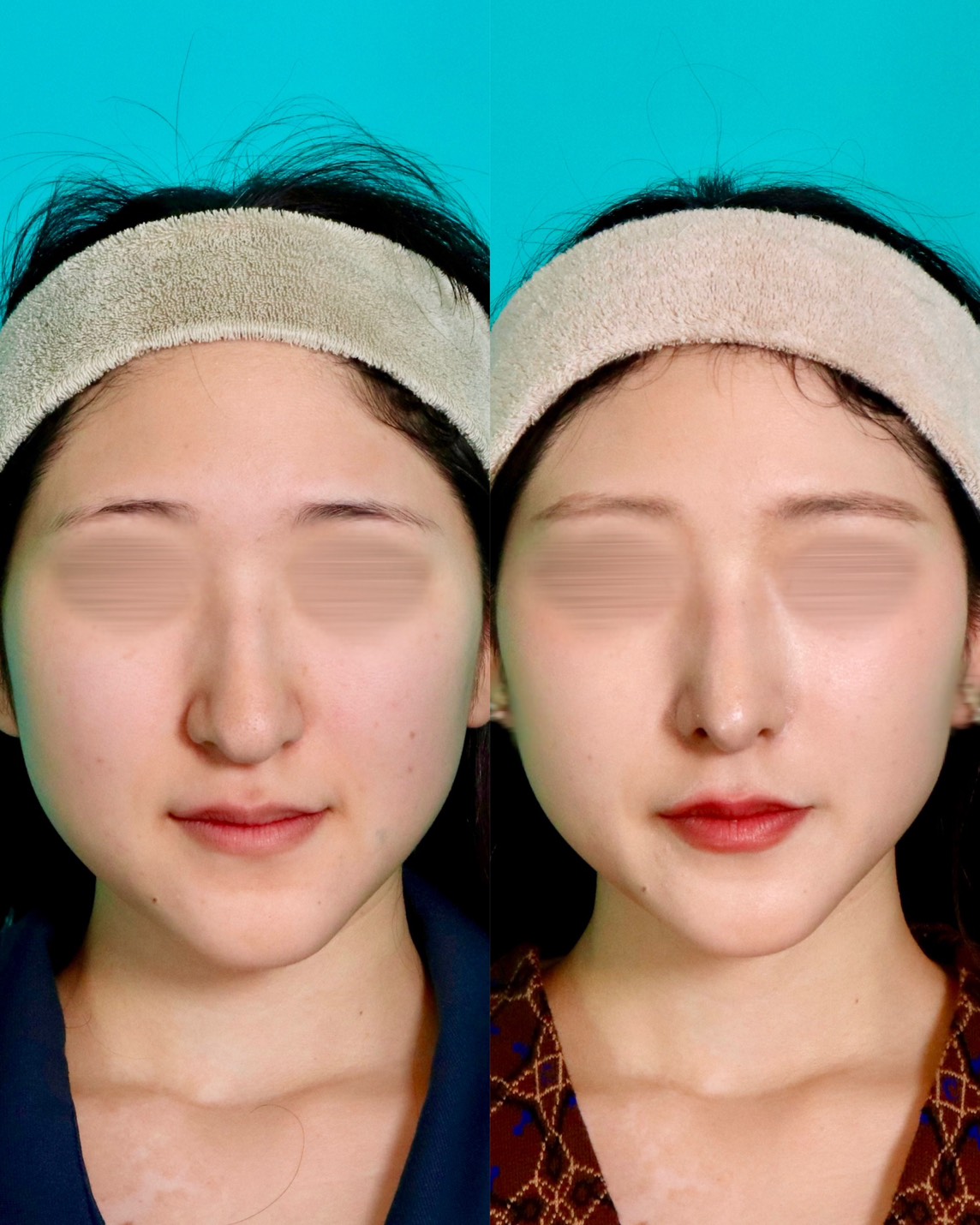 鼻尖形成施術前後イメージ