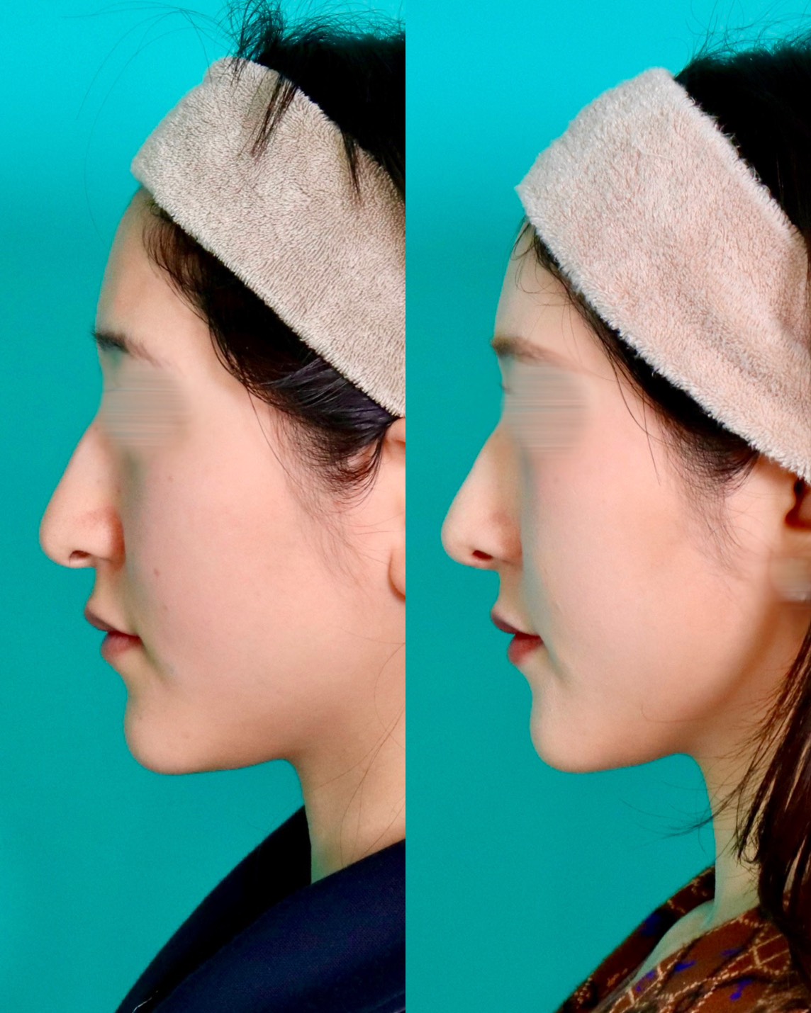 施術前後イメージ