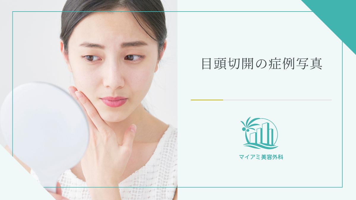 目頭切開の症例写真