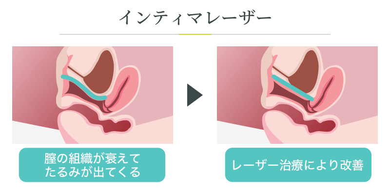 インティマレーザー