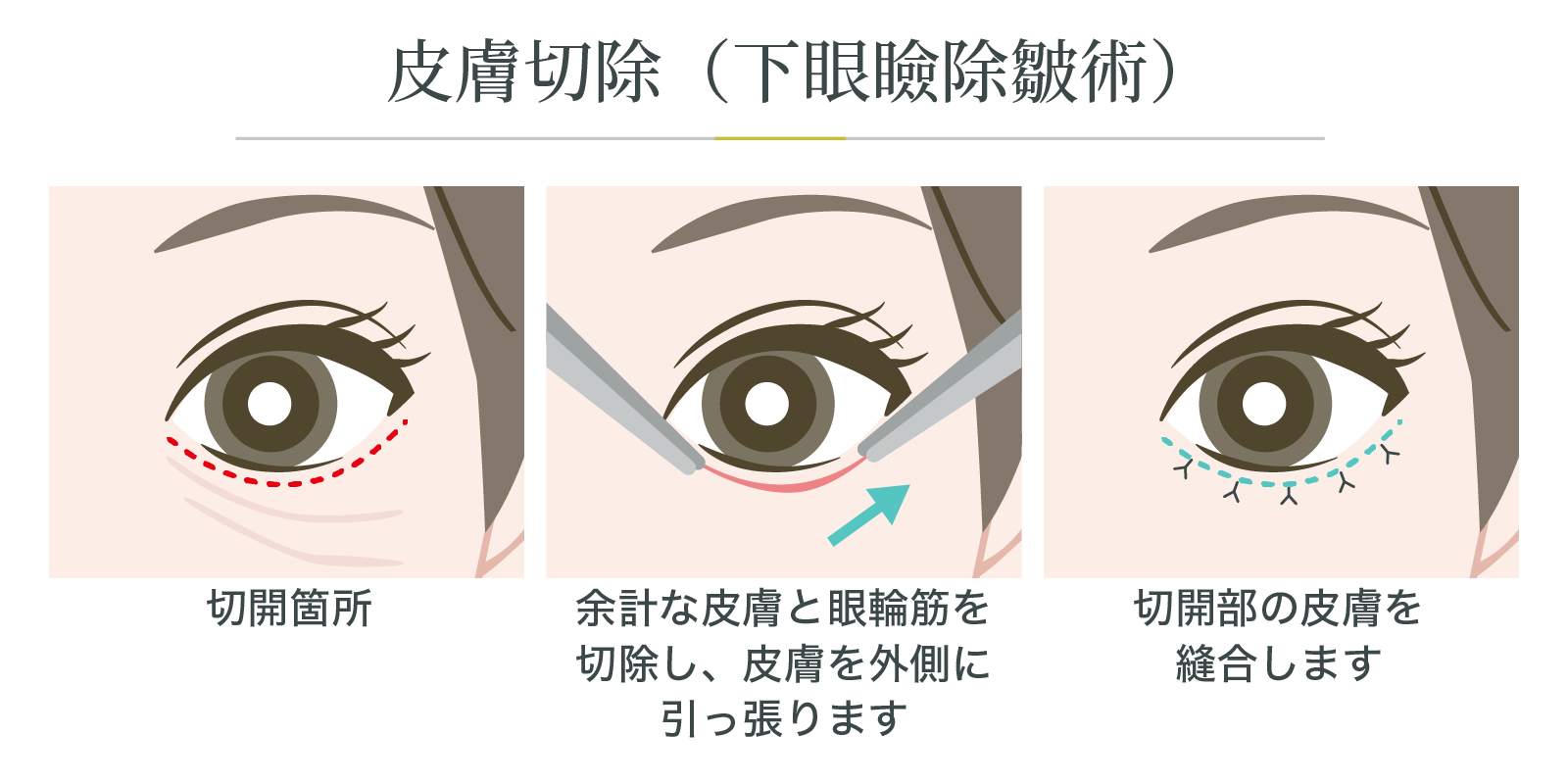 皮膚切除（下眼瞼除皺術）