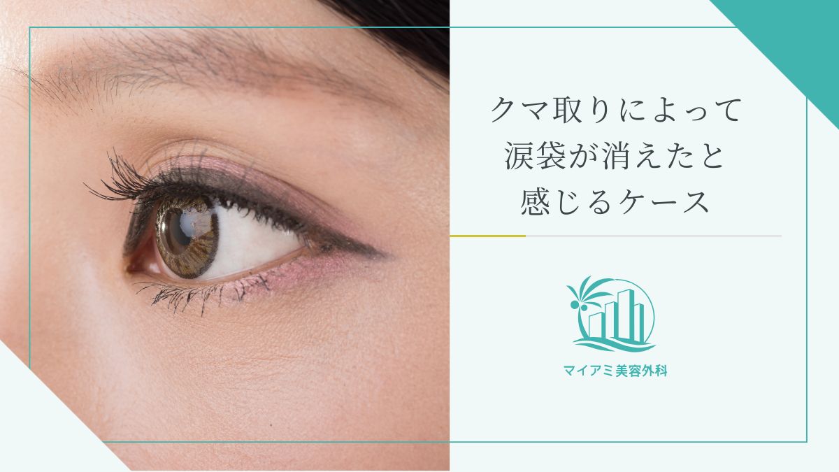 クマ取りによって涙袋が消えたと感じるケース