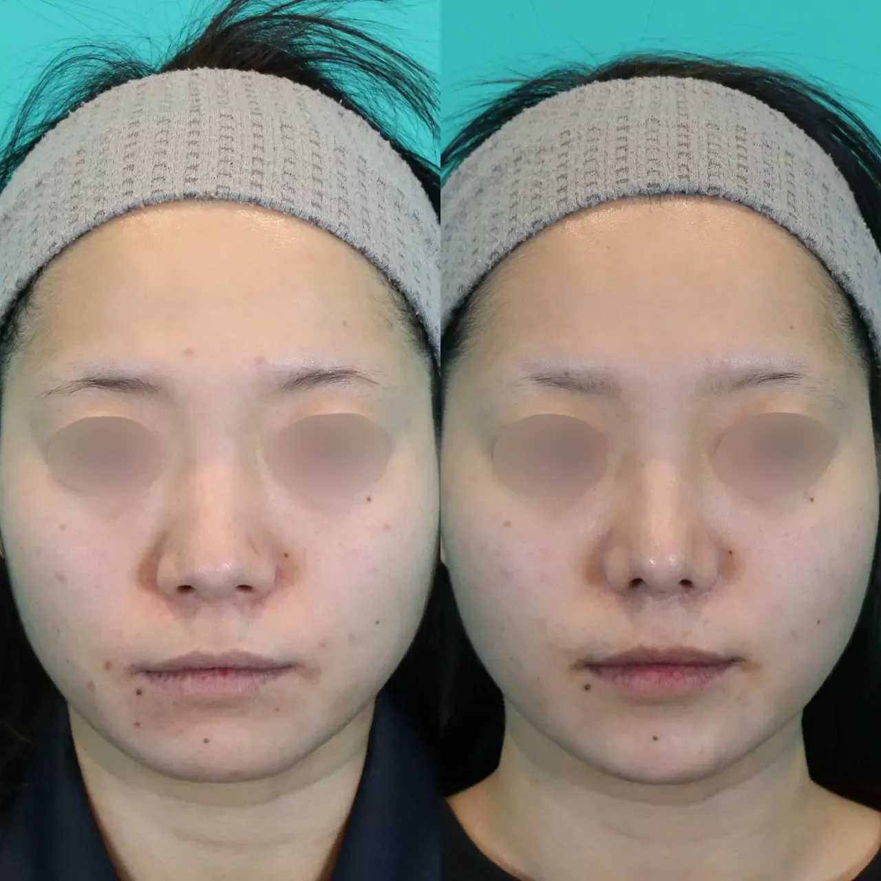 施術前後イメージ