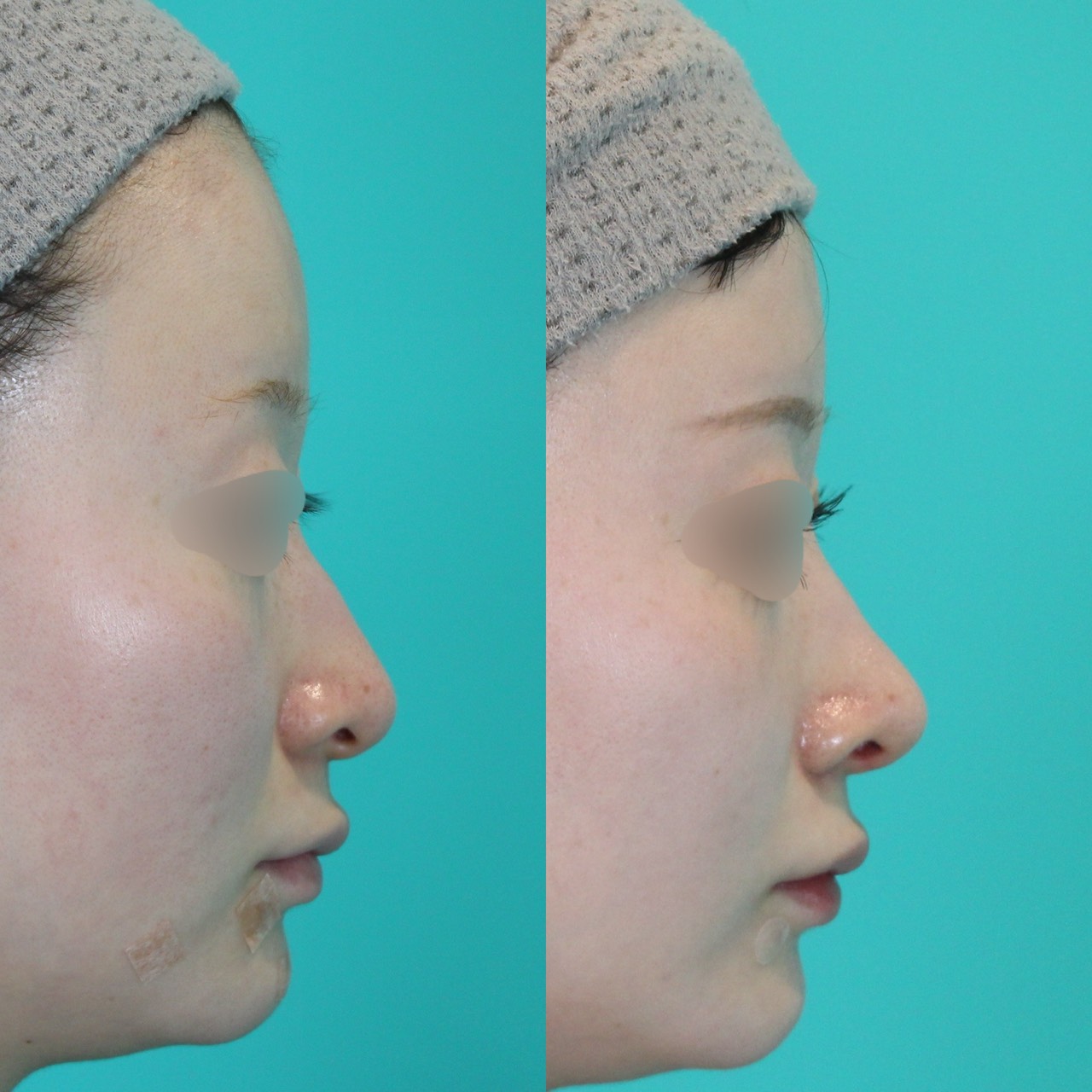 施術前後イメージ