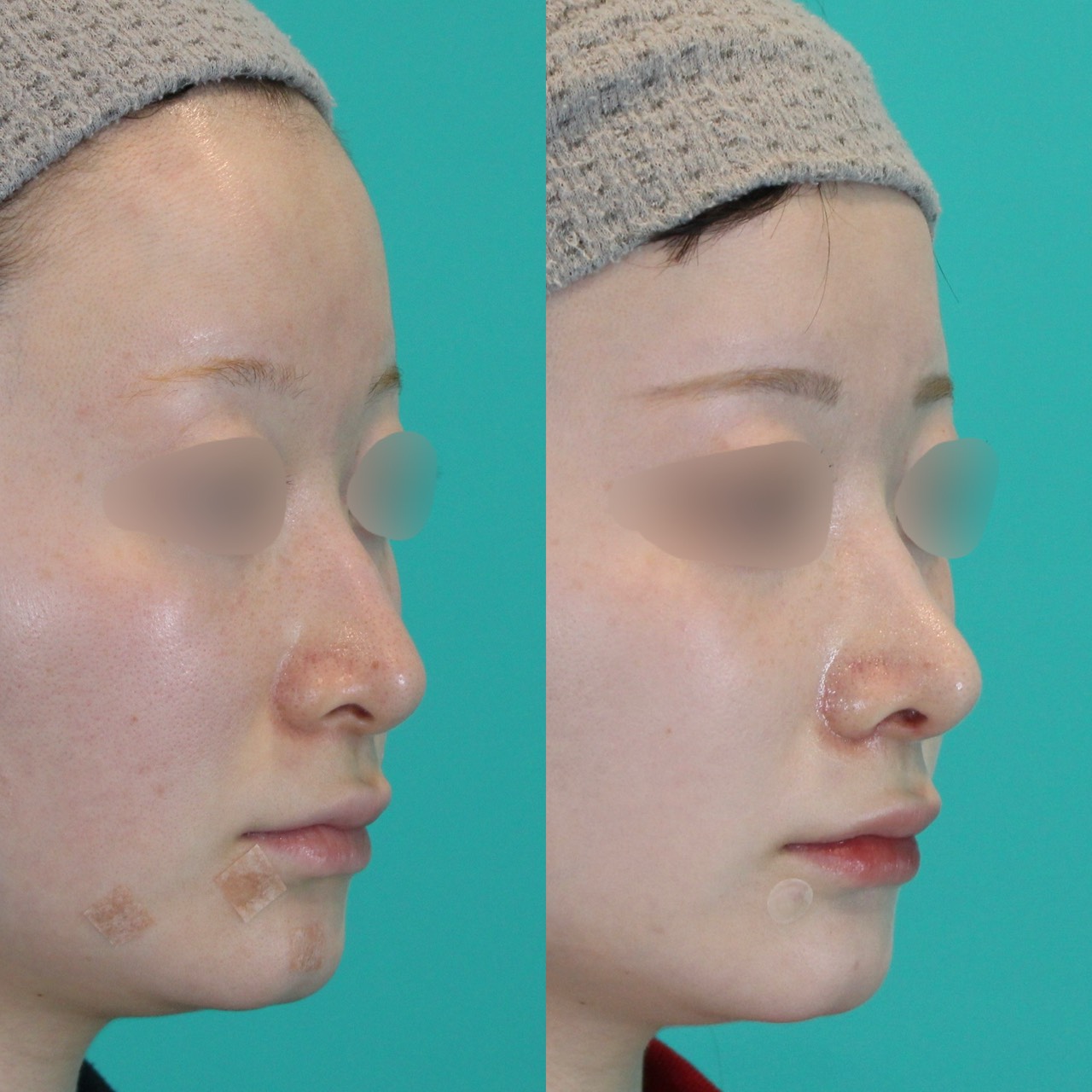 施術前後イメージ