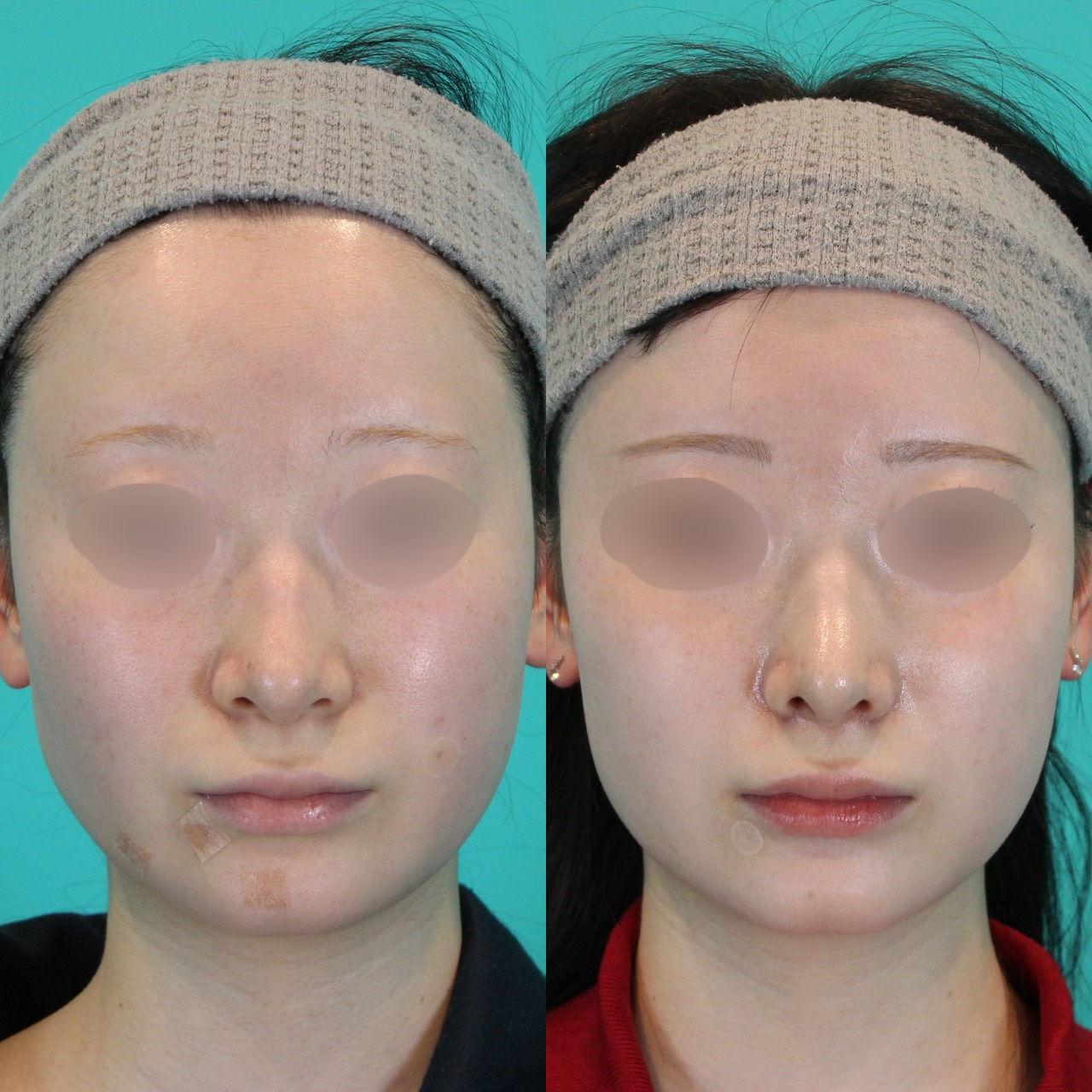 施術前後イメージ