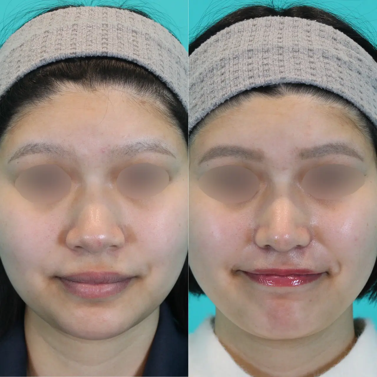 施術前後イメージ