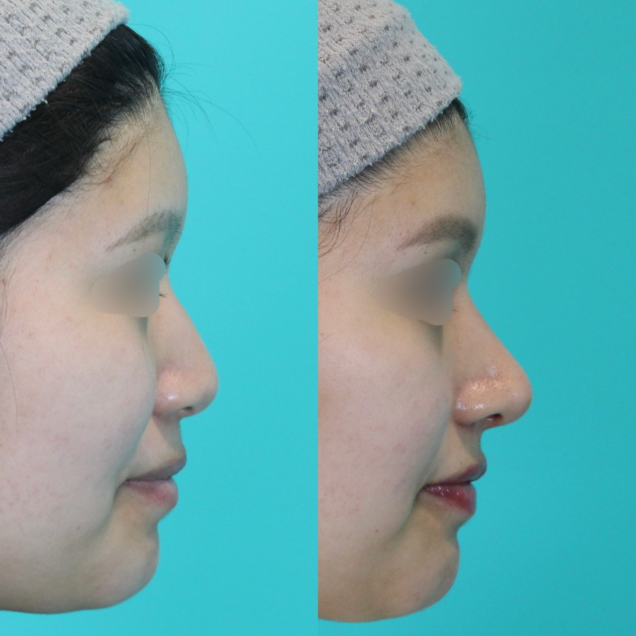 施術前後イメージ