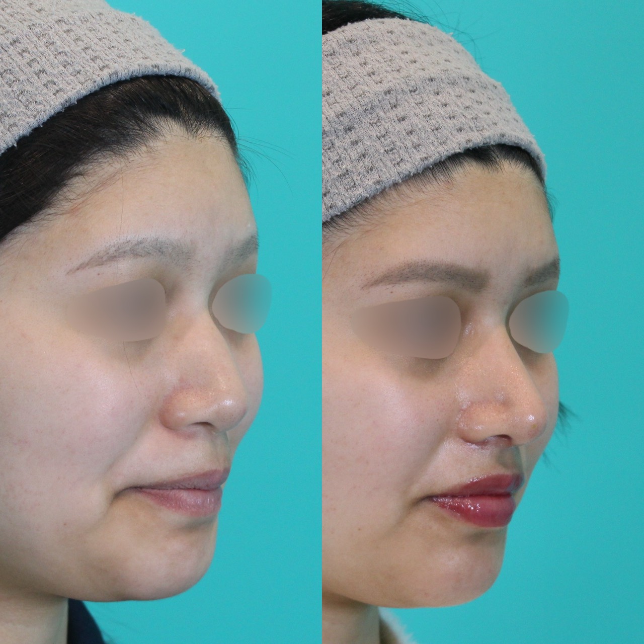 施術前後イメージ