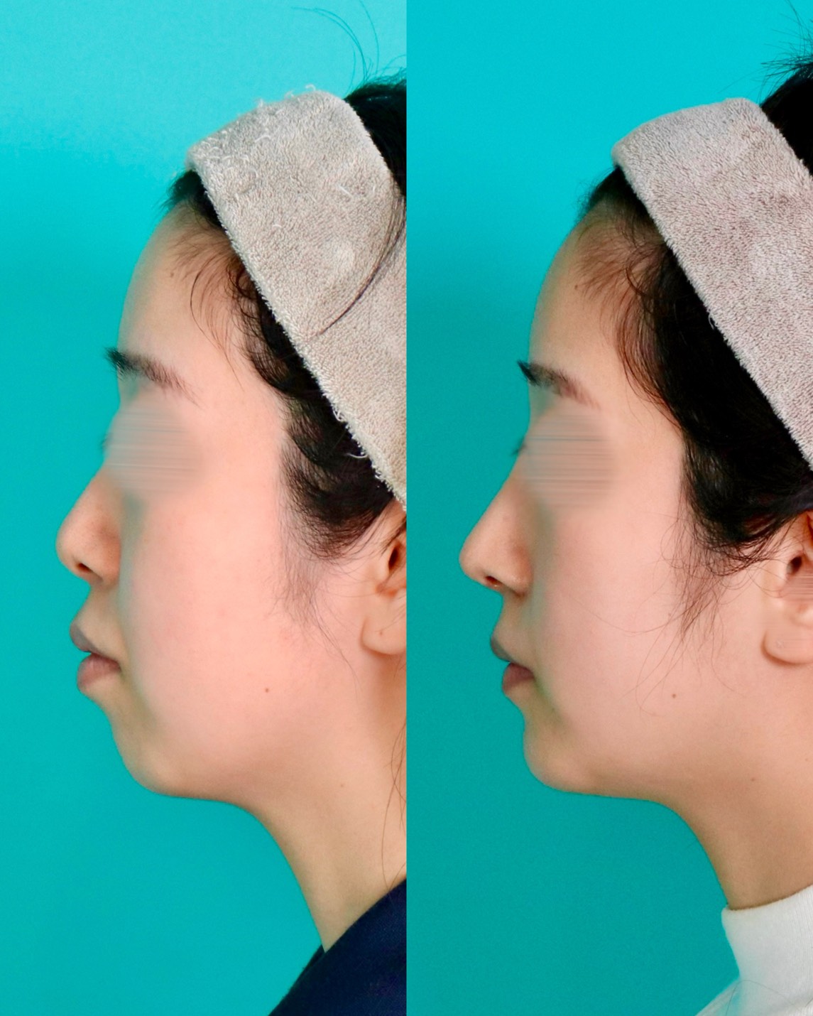 施術前後イメージ